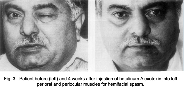 Two views of hemifacial spasm patient