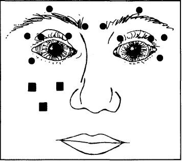 sketch of face showing injection sites
